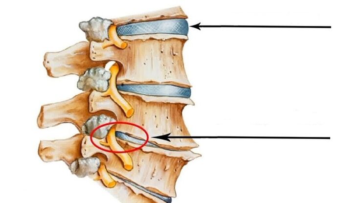 Lesión na columna vertebral en osteocondrose cervical