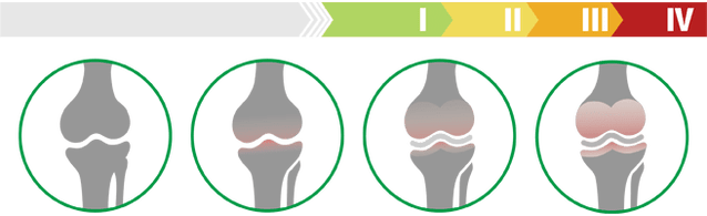 Fases clínicas da artrose do xeonllo (grao de artrose da articulación do xeonllo)