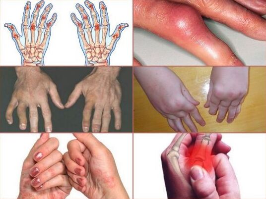 Dor nas articulacións dos dedos