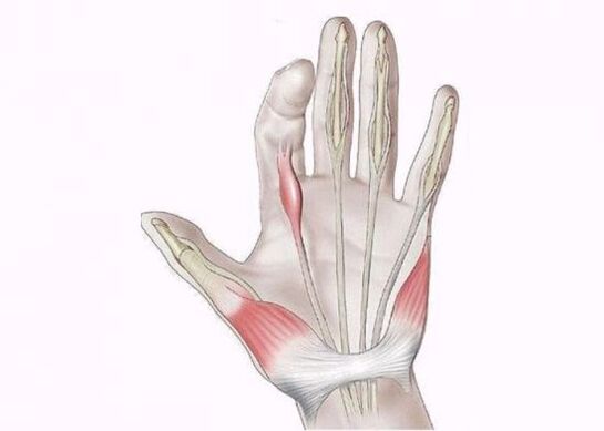 Inflamación dos tendóns como causa de dor nas articulacións dos dedos