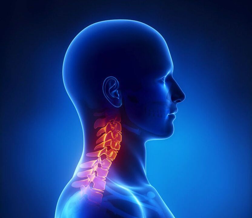 A osteocondrose cervical é unha patoloxía da columna vertebral que podes eliminar na casa