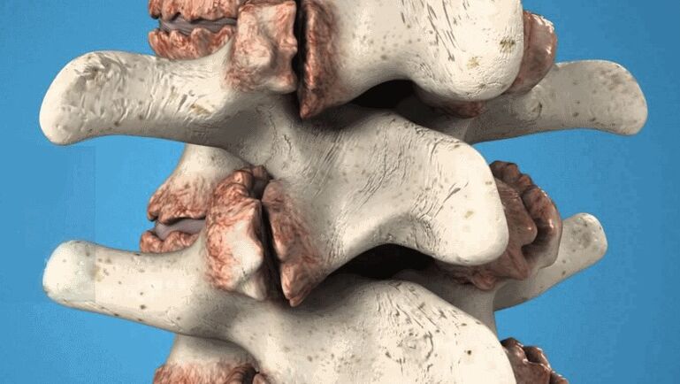 Osteófitos da columna vertebral como causa da dor nas costas
