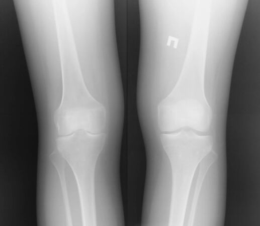 A imaxe x -ray da articulación do xeonllo