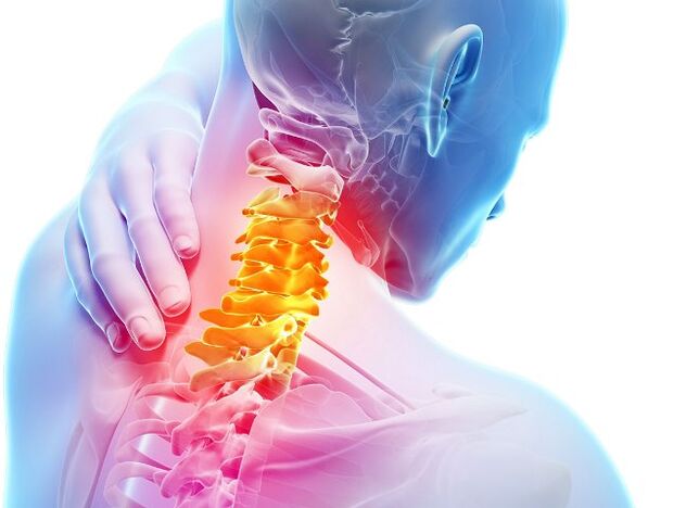 Síntomas e etapas do desenvolvemento da osteocondrose cervical