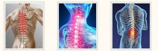 Lesións de columna vertebral de osteocondrosis