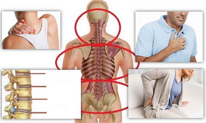 Localizacións de enfermidade para osteocondrose