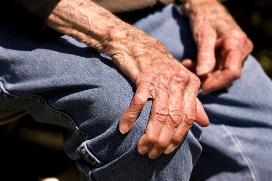 A osteoartrite é unha enfermidade relacionada coa idade que ocorre en persoas maiores