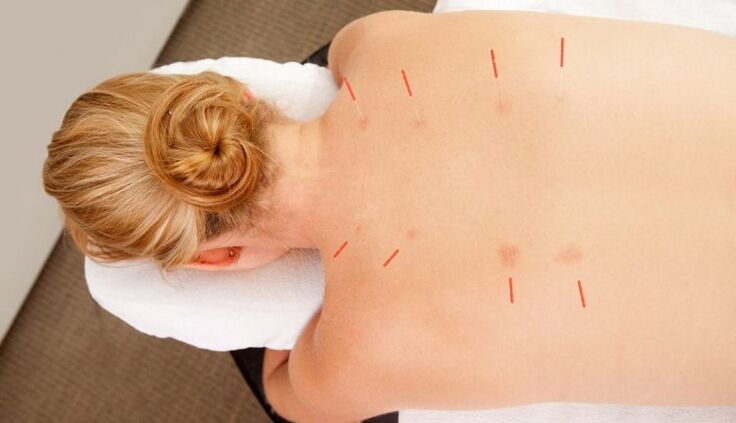 A acupuntura para a osteocondrose torácica, que ten moitos beneficios